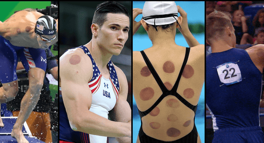 5 Reasons Athletes Swear by Electric Cupping Therapy